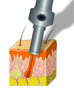 implante-capilar-FUE